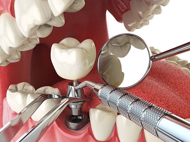 Best Emergency Treatment for Dental Infections or Abscesses in Coon Rapids, IA